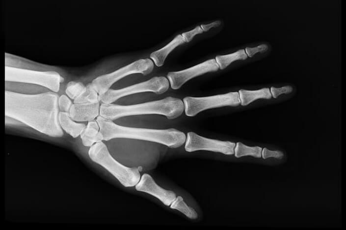 x-ray of a hand